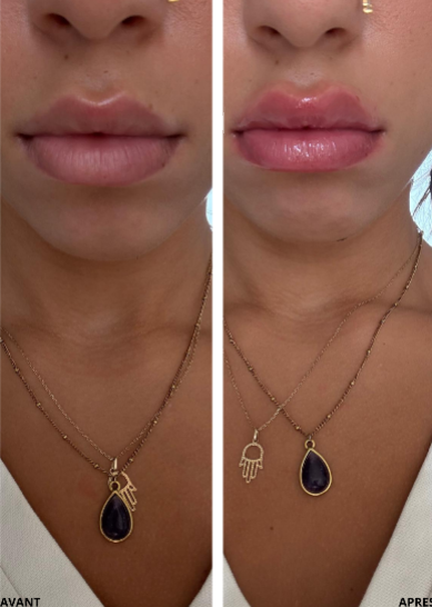 Lip Plump Lindessence